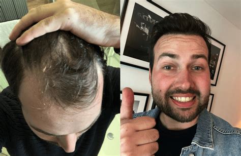 De Wenselijkheid Van Haartransplantatie Bij Mannen