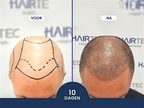 Eerlijke Haartransplantatie Kosten: Een Heldere Uitleg