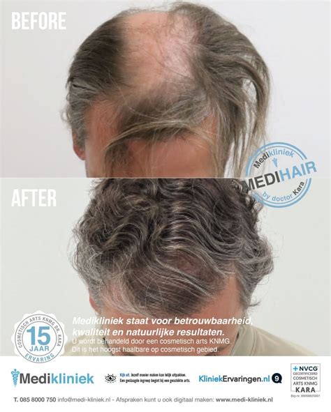 Haartransplantatie En De Psychologie Van Haarverlies