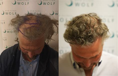 Haartransplantatie Voor En Na: Succesverhalen